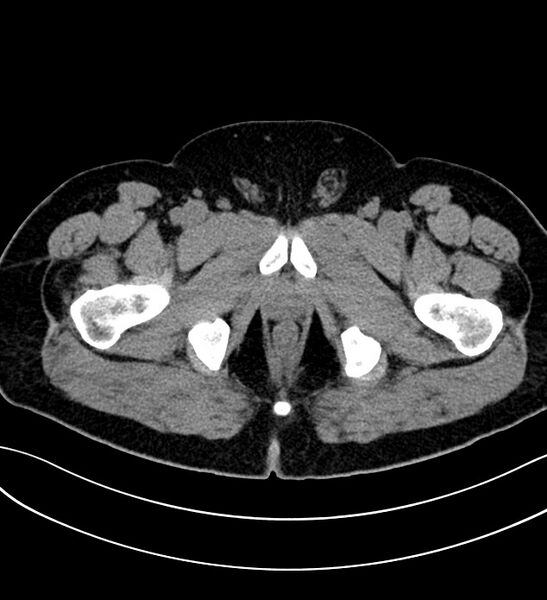 File:Chromophobe renal cell carcinoma (Radiopaedia 84286-99573 Axial non-contrast 69).jpg