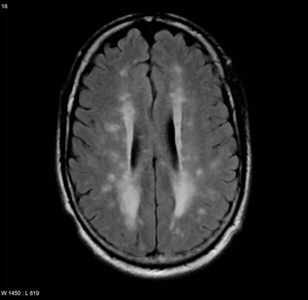 File:Chronic hypertensive encephalopathy (Radiopaedia 4564-6686 Axial FLAIR 11).jpg