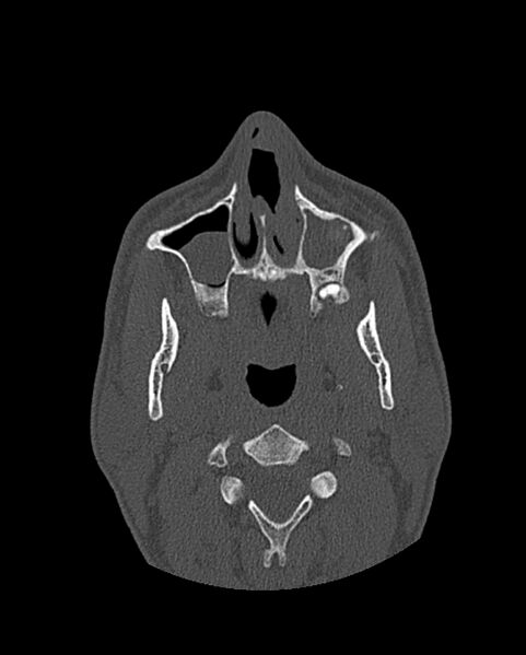 File:Chronic maxillary sinusitis caused by a foreign body (Radiopaedia 58521-65676 Axial bone window 75).jpg