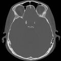 Chronic otomastoiditis (Radiopaedia 27138-27309 Axial bone window 53).jpg