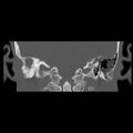 Chronic otomastoiditis (Radiopaedia 27138-27309 Coronal bone window 14).jpg