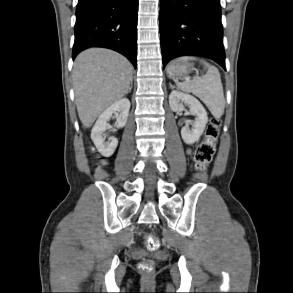 File:Chronic pancreatitis (Radiopaedia 21022-20949 C 14).jpg