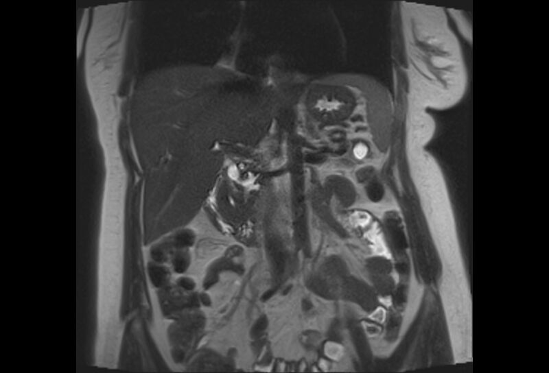 File:Chronic pancreatitis - pancreatic duct calculi (Radiopaedia 71818-82250 Coronal T2 14).jpg