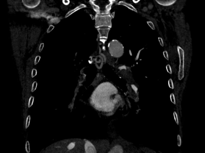 File:Chronic pulmonary embolism (Radiopaedia 91241-108843 A 65).jpg