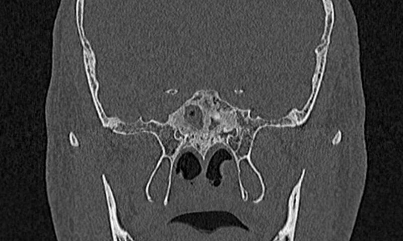 File:Chronic rhinosinusitis (Radiopaedia 65079-74075 Coronal bone window 70).jpg