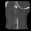 Clay-shoveler fracture (Radiopaedia 22568-22590 Sagittal bone window 39).jpg
