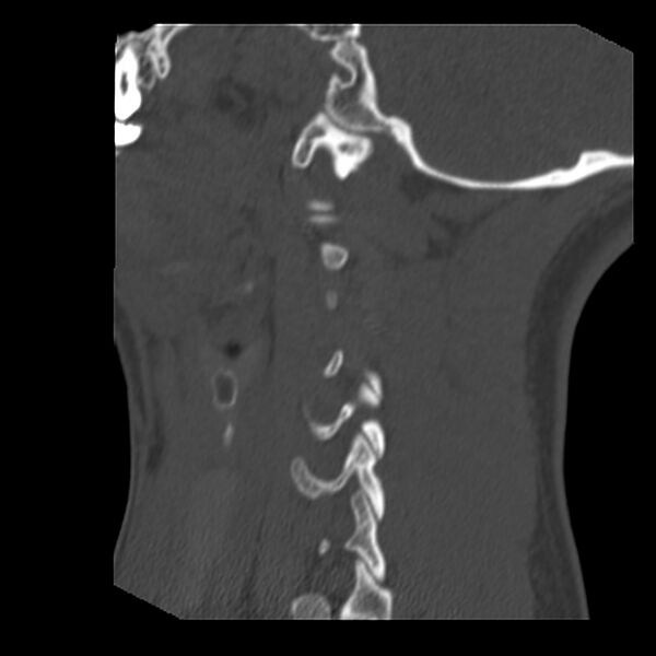 File:Clay-shoveler fracture (Radiopaedia 22568-22590 Sagittal bone window 39).jpg