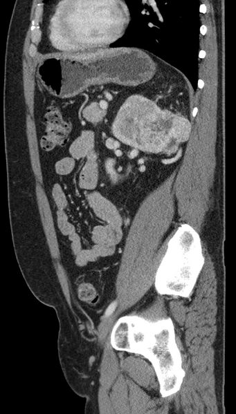 File:Clear cell renal cell carcinoma (Radiopaedia 61449-69393 G 32).jpg