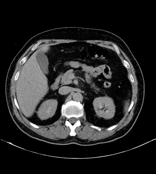 File:Clear cell renal cell carcinoma (Radiopaedia 85006-100539 H 9).jpg