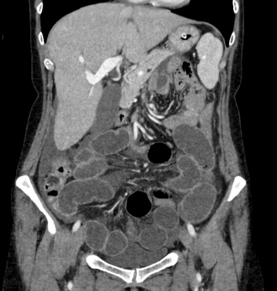 File:Closed loop small bowel obstruction (Radiopaedia 71211-81508 B 36).jpg