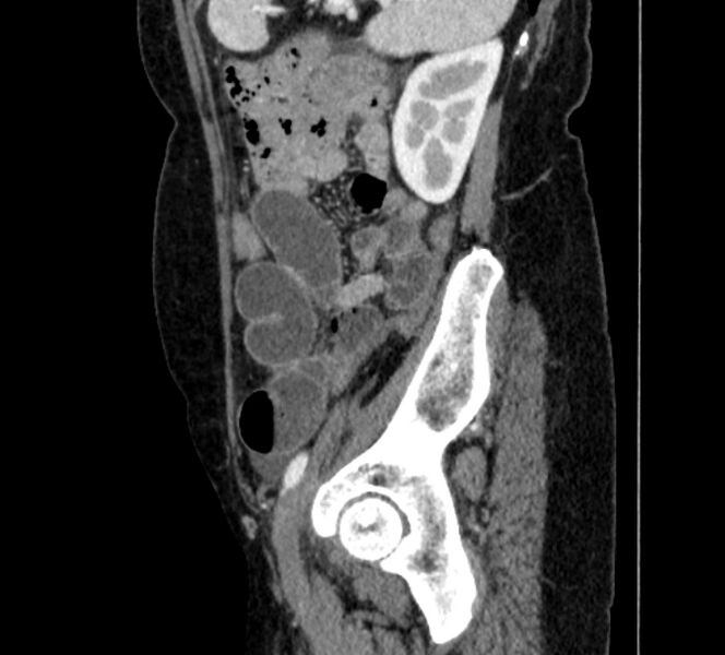 File:Closed loop small bowel obstruction (Radiopaedia 71211-81508 C 128).jpg