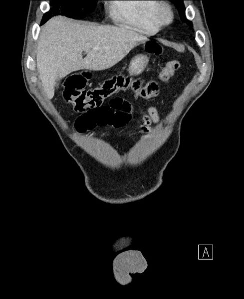 File:Closed loop small bowel obstruction - internal hernia (Radiopaedia 57806-64778 A 19).jpg