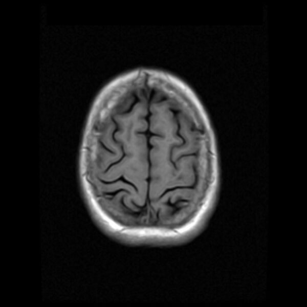 File:Colloid cyst with hydrocephalus (Radiopaedia 9373-10065 Axial T1 17).jpg