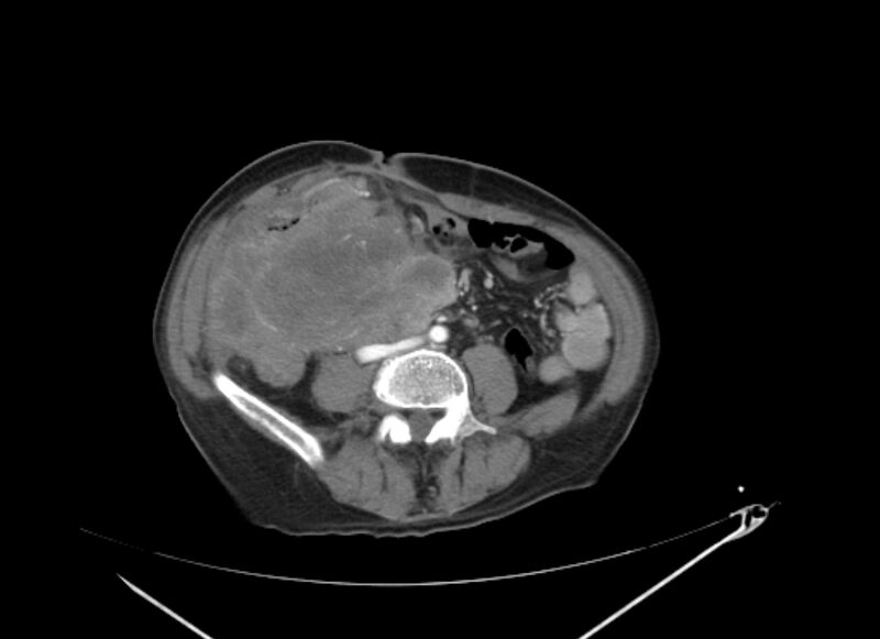 File:Colon cancer mimicking renal cell carcinoma (Radiopaedia 28986-29335 B 47).jpg