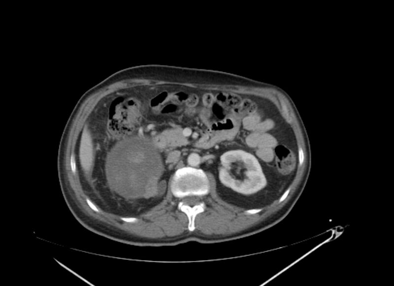 File:Colon cancer mimicking renal cell carcinoma (Radiopaedia 28986-29335 C 30).jpg