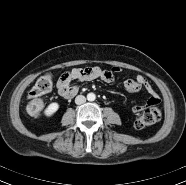 File:Colon carcinoma with hepatic metastases (Radiopaedia 29477-29961 A 63).jpg