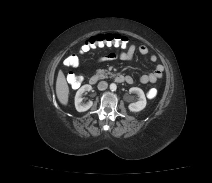 File:Colonic diverticulosis (Radiopaedia 22934-22957 A 31).jpg