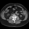 Colonic fistula (Radiopaedia 16047-15707 Axial non-contrast 28).jpg