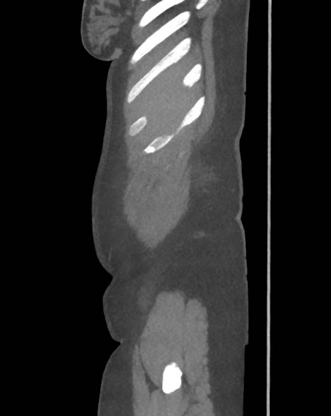 File:Colonic pseudo-obstruction (Radiopaedia 79752-92980 C 10).png