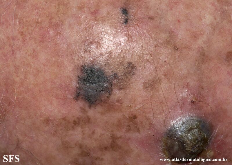 File:Melanoma (Dermatology Atlas 92).jpg