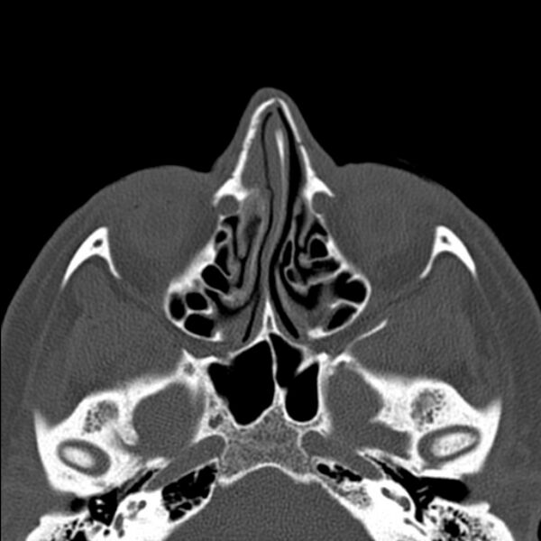 File:Nasal septal perforation (Radiopaedia 25030-25289 Axial bone window 29).jpg