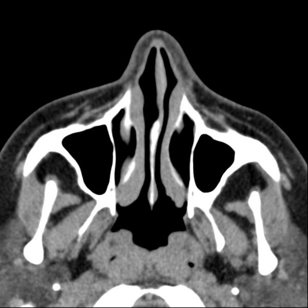 File:Nasolabial cyst (Radiopaedia 33987-35205 Axial non-contrast 15).jpg
