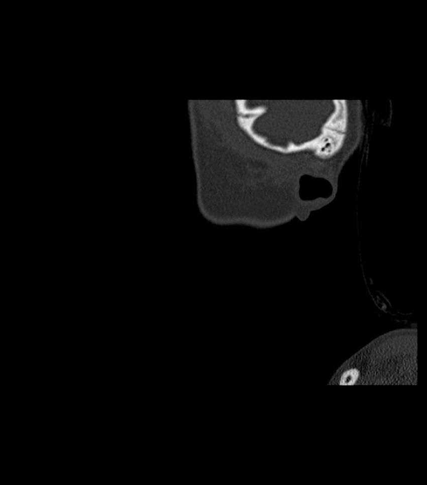 Nasoorbitoethmoid fracture (Radiopaedia 90044-107205 Sagittal bone window 134).jpg