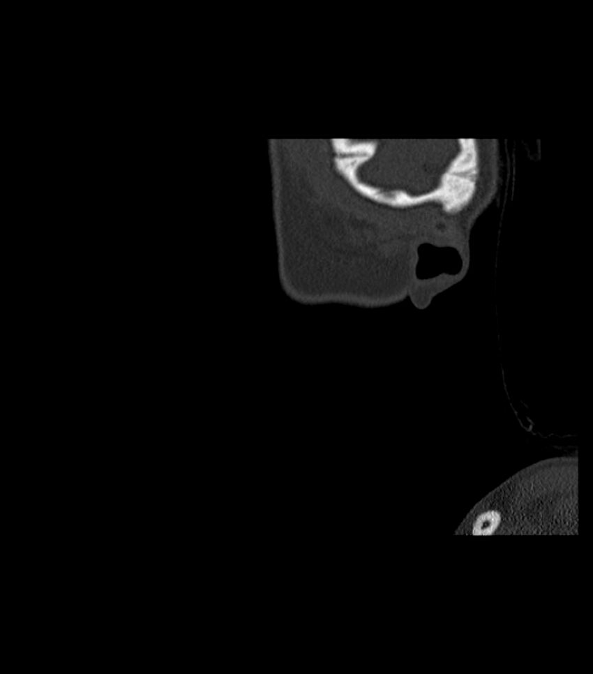 Nasoorbitoethmoid fracture (Radiopaedia 90044-107205 Sagittal bone window 135).jpg