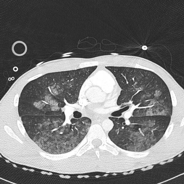 File:Near drowning (pulmonary edema) (Radiopaedia 24685-24958 lung window 25).jpg