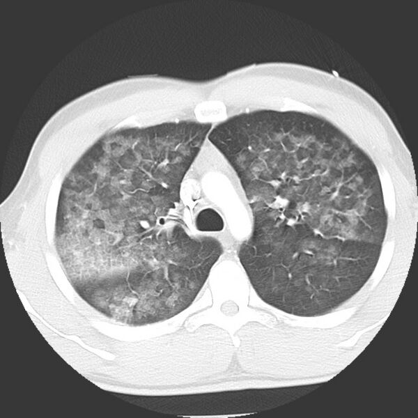 File:Near drowning pulmonary edema (Radiopaedia 16868-16591 Axial lung window 13).jpg
