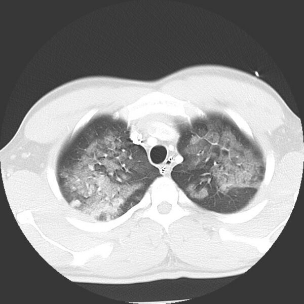 File:Near drowning pulmonary edema (Radiopaedia 16868-16591 Axial lung window 5).jpg
