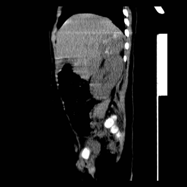 File:Neuroblastoma with skull metastases (Radiopaedia 30326-30960 B 13).jpg