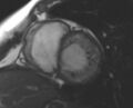 Non-compaction of the left ventricle (Radiopaedia 69436-79314 Short axis cine 160).jpg