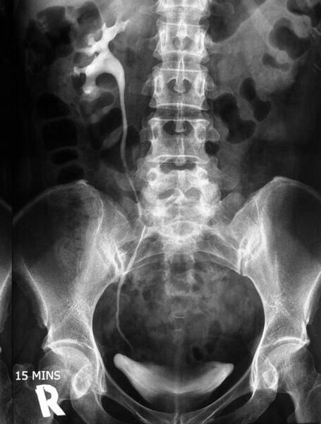 File:Non-functioning kidney on intravenous urography (Radiopaedia 22970-23000 C 1).jpg