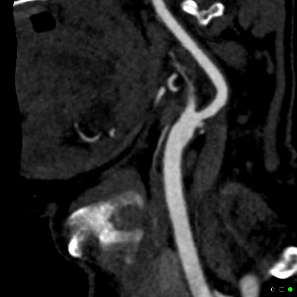 File:Non-occlusive intraluminal internal carotid artery thrombus (Radiopaedia 37751-39658 C 61).jpg