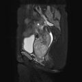 Non-puerperal uterine inversion (Radiopaedia 78343-90983 Sagittal T2 fat sat 14).jpg