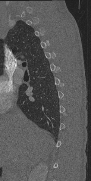 File:Normal CT thoracic spine (Radiopaedia 40181-42688 Sagittal bone window 54).png