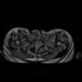 Normal MRI abdomen in pregnancy (Radiopaedia 88001-104541 Axial Gradient Echo 57).jpg