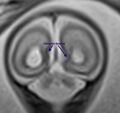 Normal brain fetal MRI - 22 weeks (Radiopaedia 50623-56604 Sulcation 3).jpg