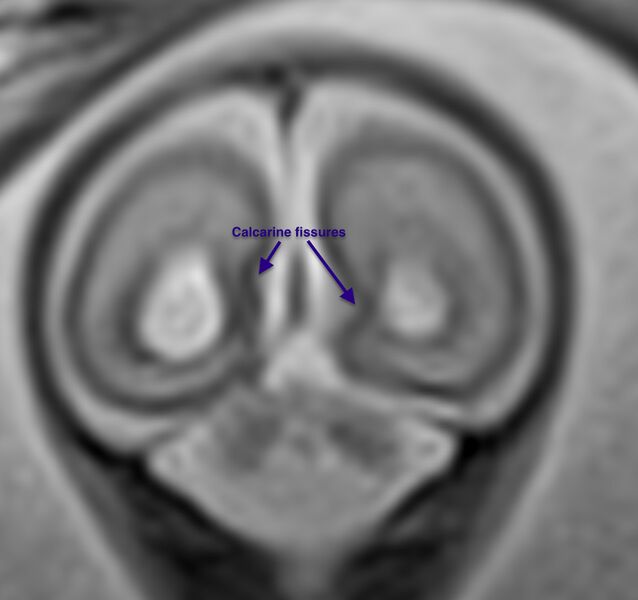 File:Normal brain fetal MRI - 22 weeks (Radiopaedia 50623-56604 Sulcation 3).jpg
