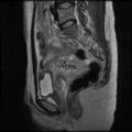 Normal female pelvis MRI (retroverted uterus) (Radiopaedia 61832-69933 Sagittal T2 15).jpg
