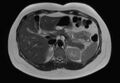 Normal liver MRI with Gadolinium (Radiopaedia 58913-66163 Axial T2 20).jpg