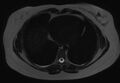 Normal liver MRI with Gadolinium (Radiopaedia 58913-66163 E 32).jpg