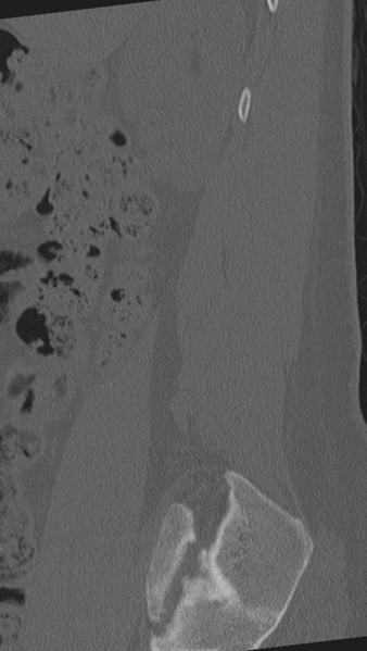 File:Normal lumbar spine CT (Radiopaedia 46533-50986 Sagittal bone window 89).png