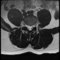 Normal lumbar spine MRI (Radiopaedia 35543-37039 Axial T2 15).png