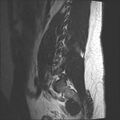 Normal lumbar spine MRI (Radiopaedia 47857-52609 Sagittal T2 2).jpg