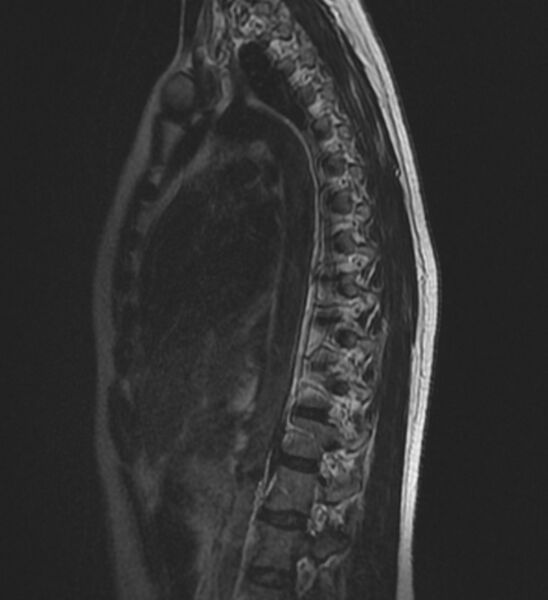 File:Normal thoracic spine MRI (Radiopaedia 41033-43781 Sagittal T2 11).jpg