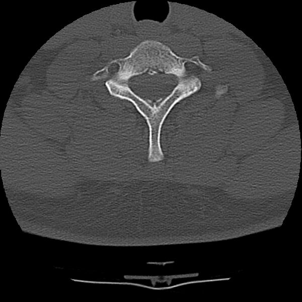 File:Normal trauma spine imaging (Radiopaedia 31753-32686 Axial bone window 66).jpg