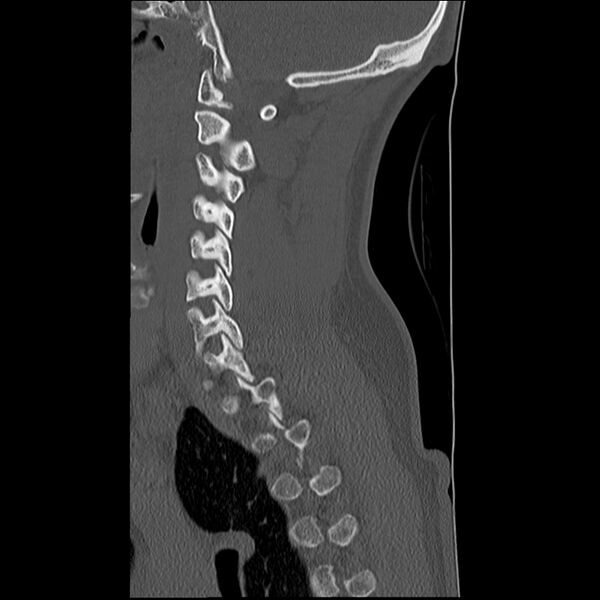 File:Normal trauma spine imaging (Radiopaedia 31753-32686 Sagittal bone window 13).jpg