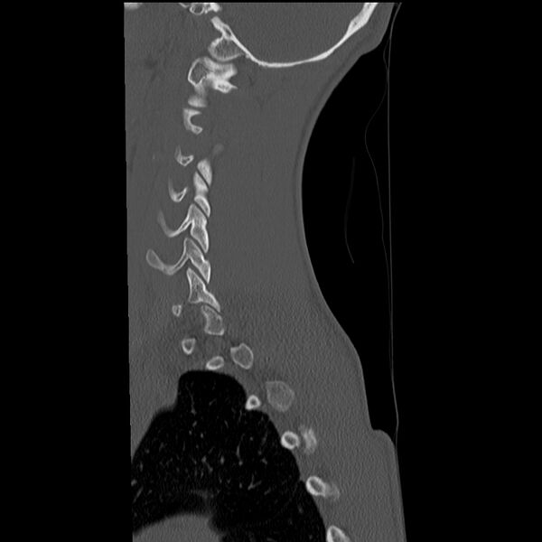 File:Normal trauma spine imaging (age 16) (Radiopaedia 45335-49358 Sagittal bone window 32).jpg